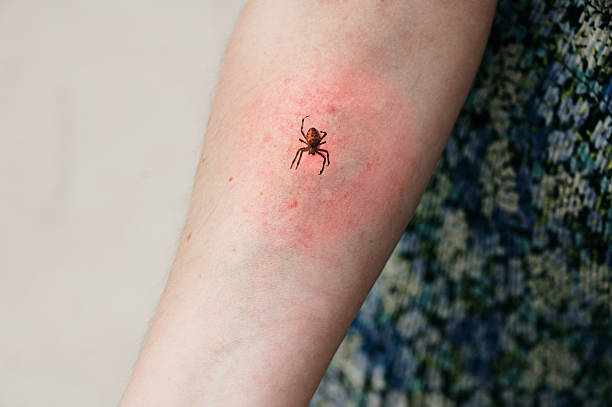 Meaning of Dreaming About Being Bitten by a Poisonous Spider