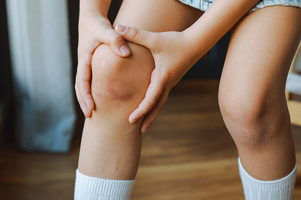 Meaning of Dreaming About Having Bruises
