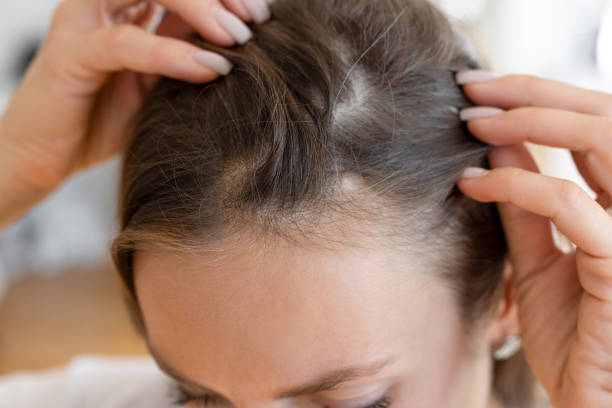 Meaning of Dreaming About Having Bugs in Your Hair
